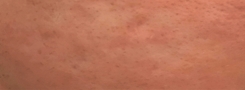 Female, age 35 — skin after Vizaz Pro-Glow