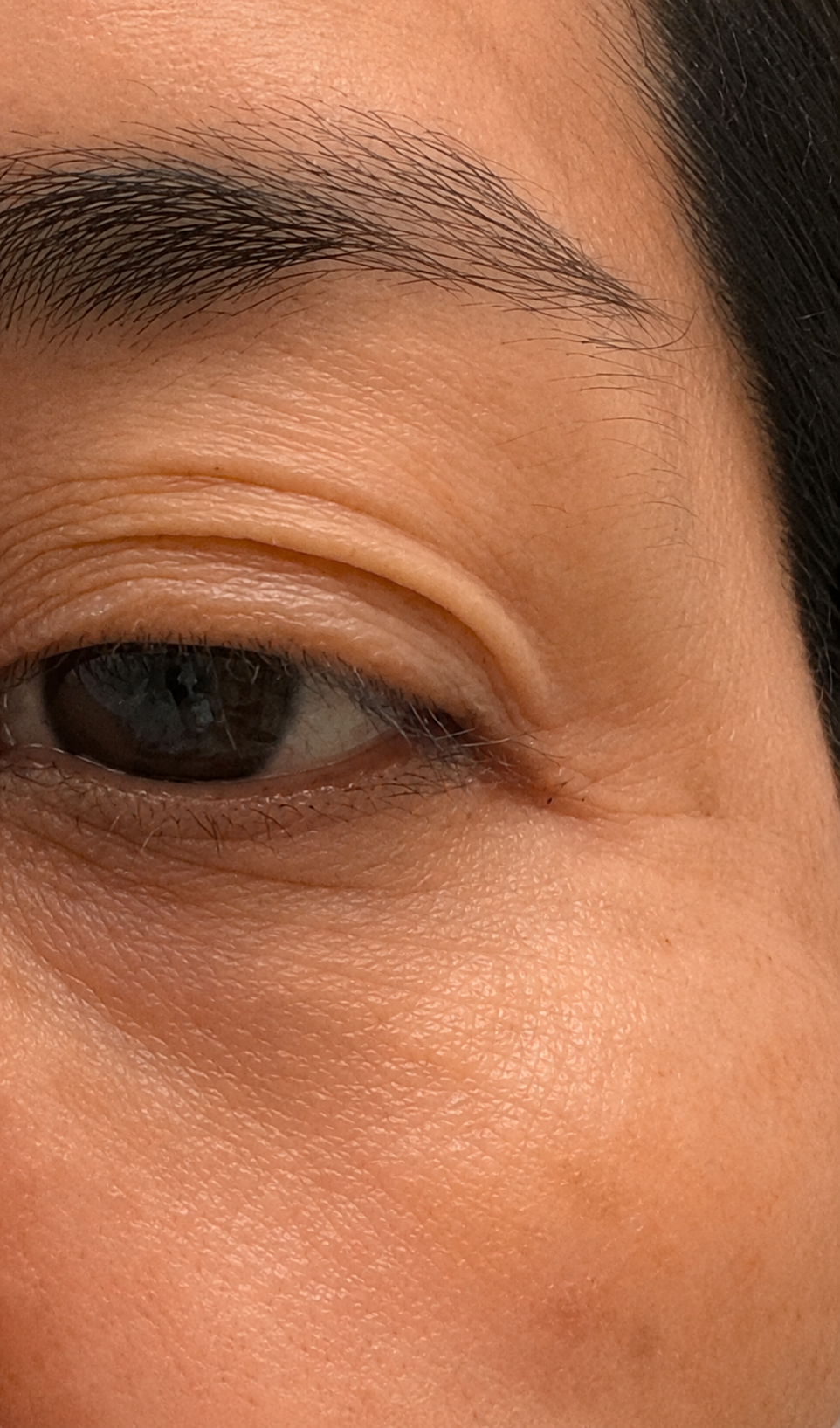Female, age 46 — eye area after Vizaz Pro-Glow