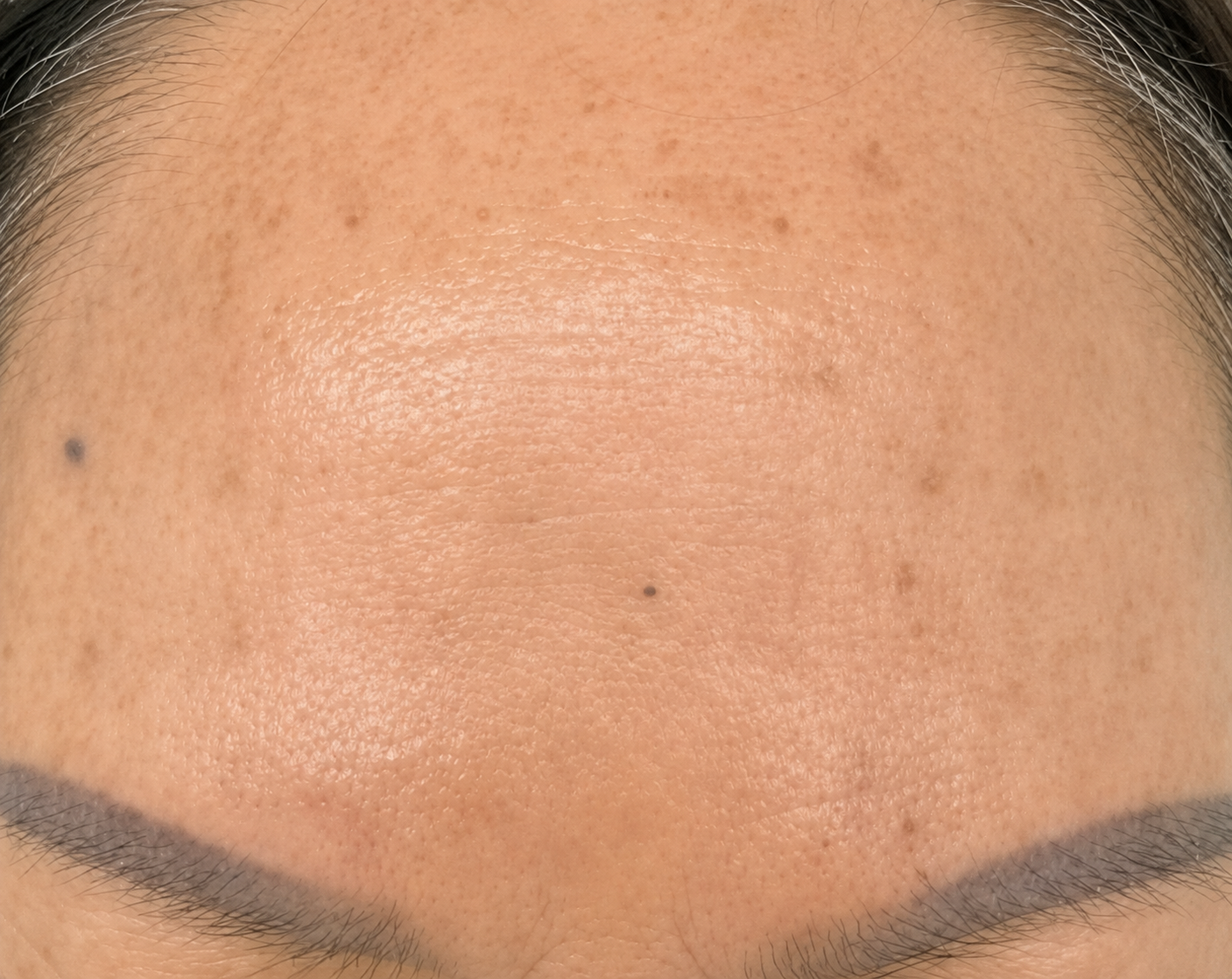 Female, age 67 — skin after Vizaz Pro-Glow
