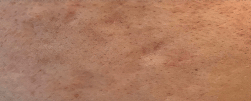 Female, age 35 — skin before Vizaz Pro-Glow