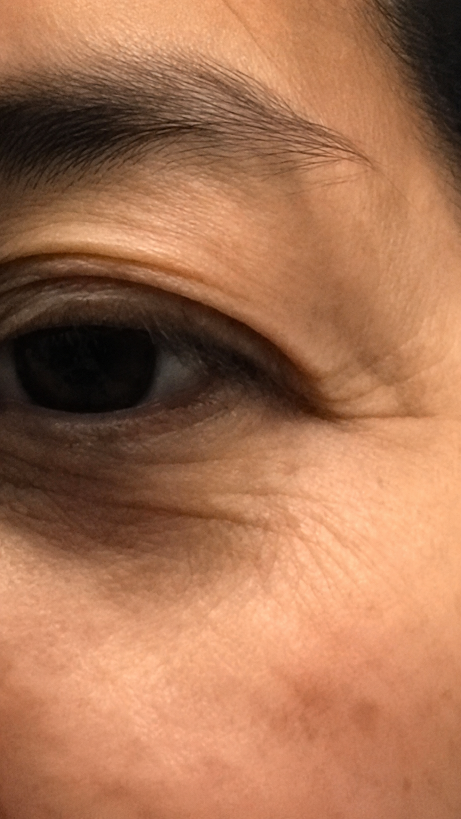 Female, age 46 — eye area before Vizaz Pro-Glow