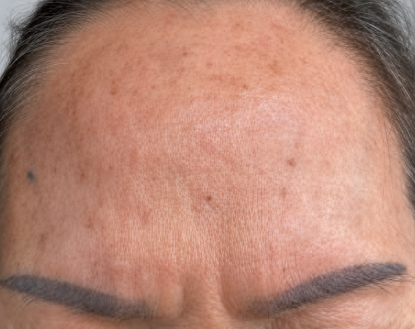 Female, age 67 — skin before Vizaz Pro-Glow
